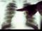 Генетические мутации вызывают опухоли лёгких у некурящих