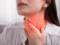 Sore throat: when to sound the alarm