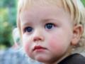 Сосудистая сетка на лице – как помочь ребенку?