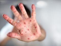 The number of measles cases in Zaporozhye close to a hundred
