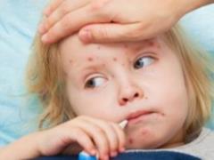 В столице зафиксировано 80 случаев заболевания корью
