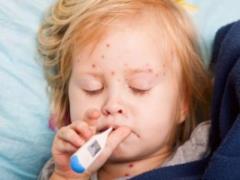 In the Chernivtsi region, almost 500 people fell ill with measles