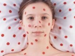 The number of measles cases in Ukraine is growing