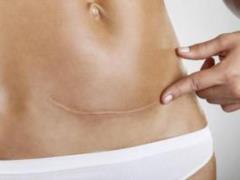 Cesarean section: effects and recovery
