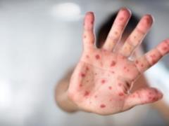In Ukraine, another death from measles