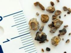 Медики рассказали, в каких местах организма могут образовываться камни
