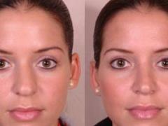 Rhinoplasty - nose shape correction