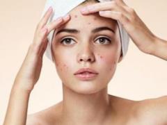 Do not do this: 7 bad habits that lead to the appearance of acne