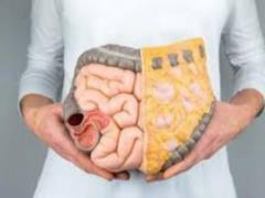 Медики назвали поради, які допоможуть запобігти раку кишечника