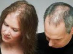 Doctors named the main causes of alopecia