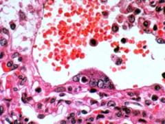 Already nine people were victims of an incurable infection