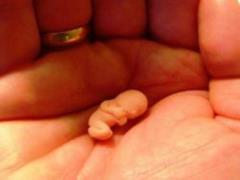 Doctors told how to prevent a miscarriage