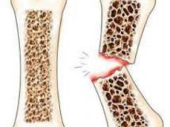Scientists: weight loss makes the bones more fragile