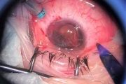 Ekaterinburg ophthalmologists saved the eye of a 10-year-old boy after a deep injury by a fragment of firecracker