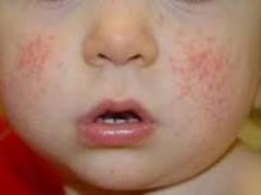 Uliana Suprun named the cause of the rash on the body