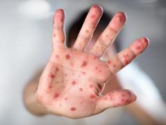 The Ministry of Health announced a decrease in the incidence of measles