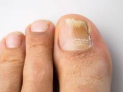 How to get rid of nail fungus on the legs and arms?