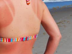 Suprun told how to treat sunburn