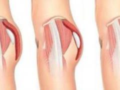 As in Kardashian: Surgeons talked about high mortality due to an increase in the buttocks