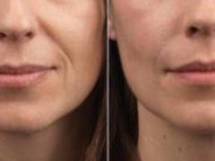 How to get rid of nasolabial folds