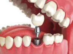 Prostheses to replace defects
