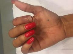 A special case: an American woman has a phalanx of a finger bitten off by cougar