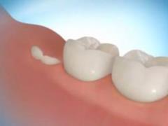 Suprun told the truth about the wisdom tooth