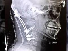 American survived  internal decapitation  and survived