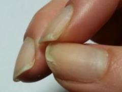 Why nails exfoliate and what to do about it