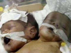 Два малыша в одном теле. Необычные близнецы родились в Йемене