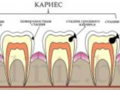Кариес переносится поцелуем? Может ли гниение рта быть заразным?