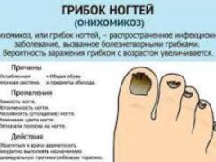 Дерматологи объяснили, как распознать грибок ногтей
