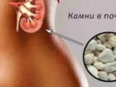Камни в почках: неожиданные причины появления