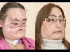 После нападения бывшего мужа женщине пересадили лицо, но оно стало «отслаиваться»