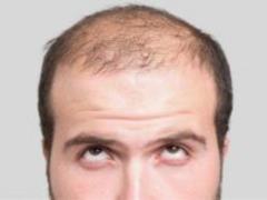 Эксперты назвали одну из главных причин облысения у мужчин