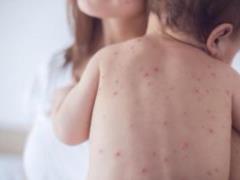 An unexpected measles hazard called