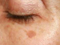 Why dark spots appear on the skin with age