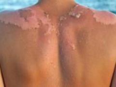 Scientists have discovered a new cause of skin cancer
