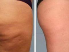 Named an easy way to get rid of cellulite