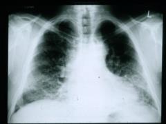 Too long and too short sleep are associated with an increased risk of pulmonary fibrosis