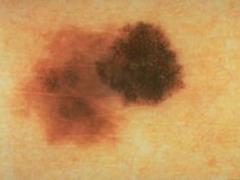 Blogger subscribers noticed a suspicious mole on his back - and saved the guy’s life