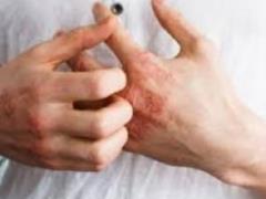 5 натуральных средств от кожной аллергии