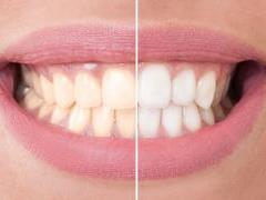 Why teeth turn yellow: non-obvious mistakes in nutrition and care