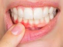 Immunosuppressor may help combat periodontal disease