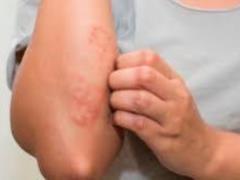 Какие кожные высыпания могут появляться при Covid-19