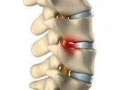 The doctor told when to operate on a hernia of the spine