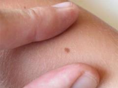 Melanoma: How to recognize impending skin cancer