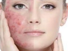 Fighting Acne: 5 Important Tips