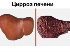 Когда цирроз печени смертельно опасен