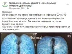 Медики показали, как Covid-19 шаг за шагом уничтожает легкие человека.